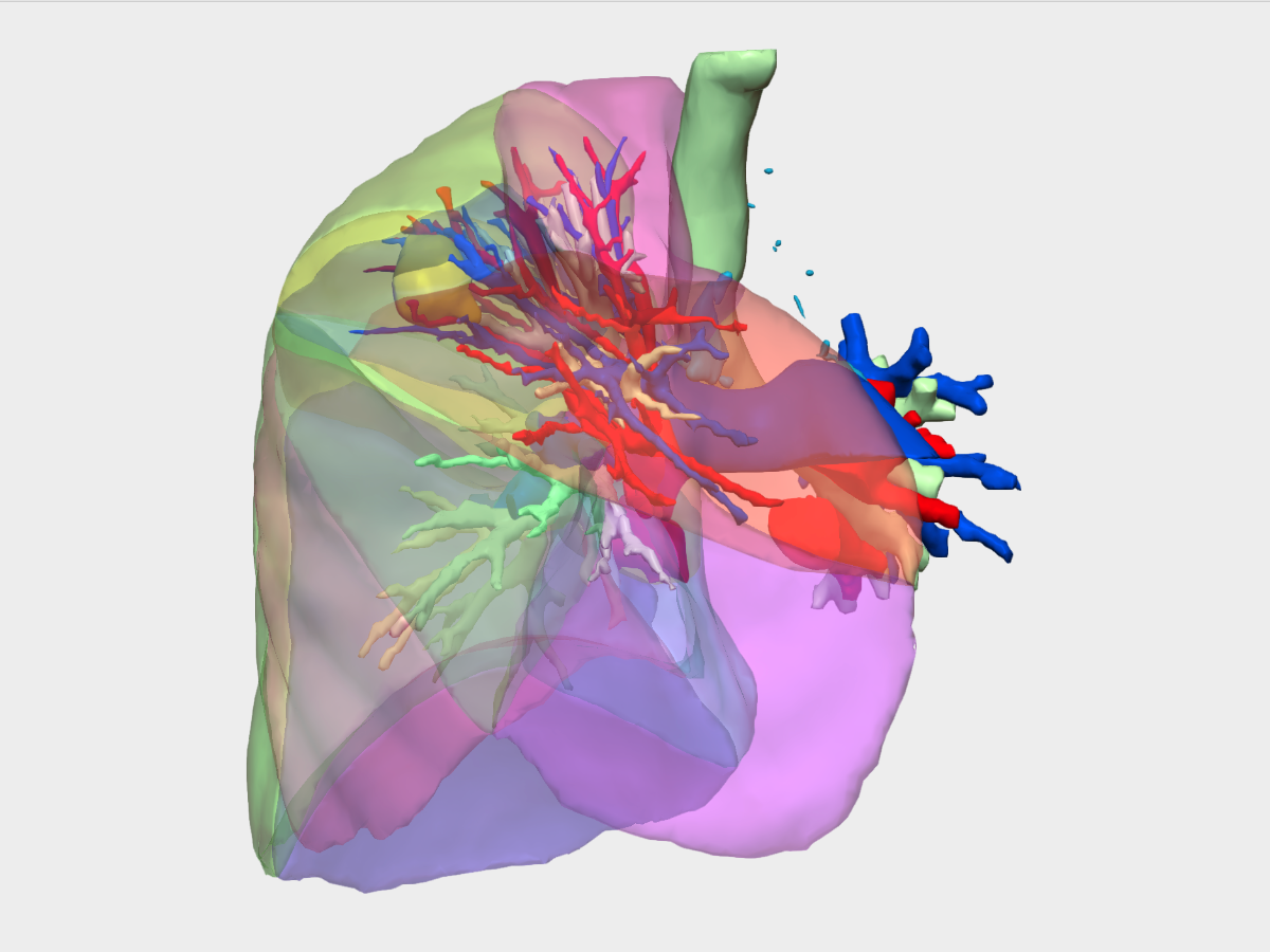 cancer pulmon reconstruccion 3d dr corona cruz