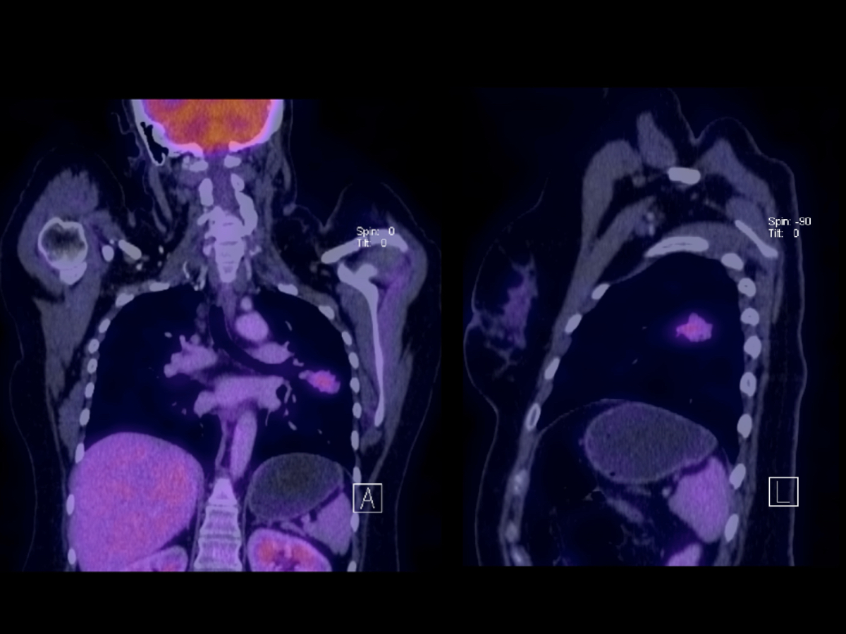 pet ct cancer pulmon dr corona cruz